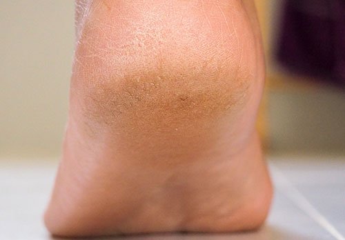 5 Skin conditions podiatrists treat - Advance Foot Clinic Podiatry
